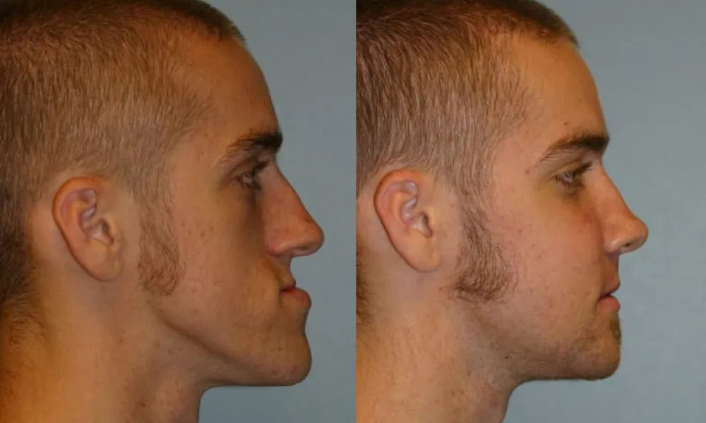 Clinical photo from Joe's corrective jaw surgery case